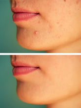 DrFormulas Cystic Acne Treatment with Zinc, Probiotics, DIM | Hormonal Acne Supplements and Scar Prevention, 1 Month Supply