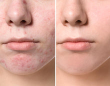 DrFormulas Cystic Acne Treatment with Zinc, Probiotics, DIM | Hormonal Acne Supplements and Scar Prevention, 1 Month Supply