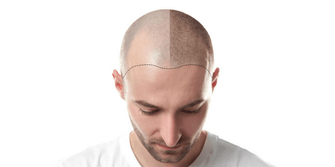 What are Some Reversible Causes of Baldness and How to Stop Balding