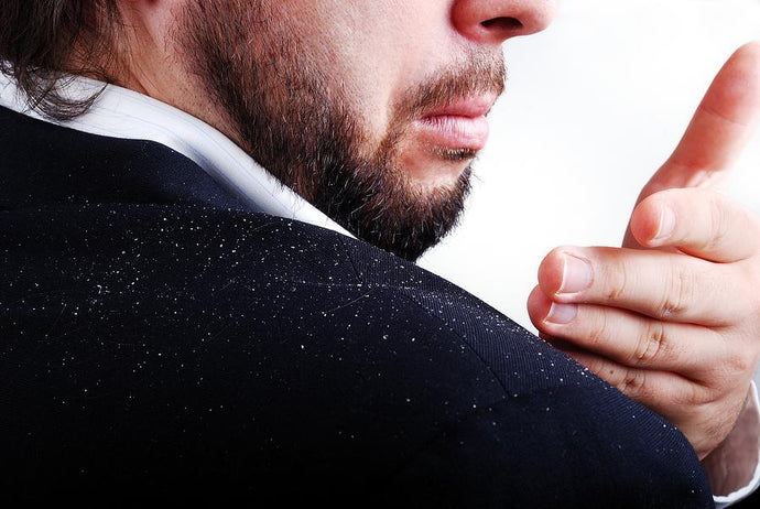 How to Get Rid of Dandruff Fast