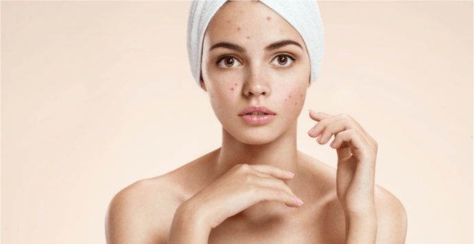 4 Best Acne Spot Treatments